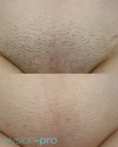 Epilare laser Elysion Pro U