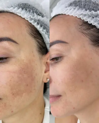 Fotorejuvenarea tenului Candela Nordlys Lia Aesthetic Clinic