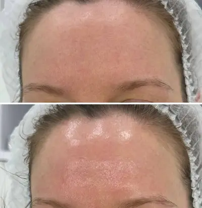 HydraFacial Lia Aesthetic Clinic