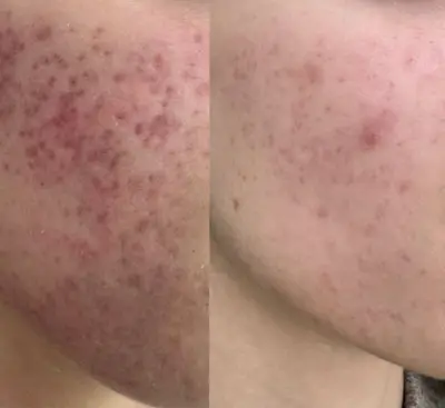 Tratamentul cicatricilor postacneice