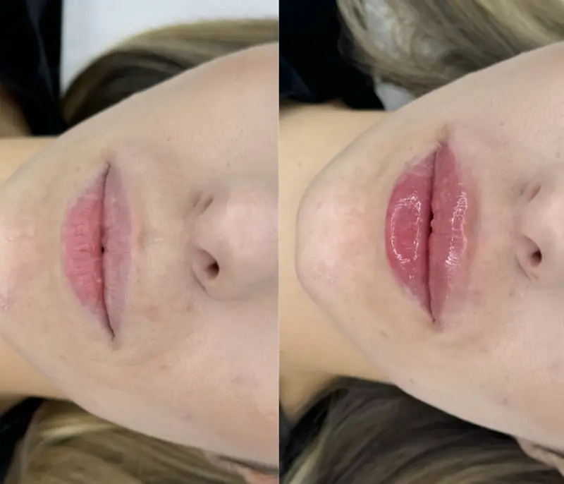 Fillere pentru volum și contur facial la Lia Aesthetic Clinic