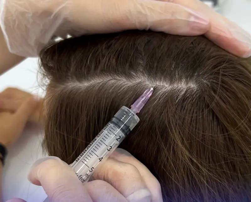 Tratamente pentru scalp la Lia Aesthetic Clinic